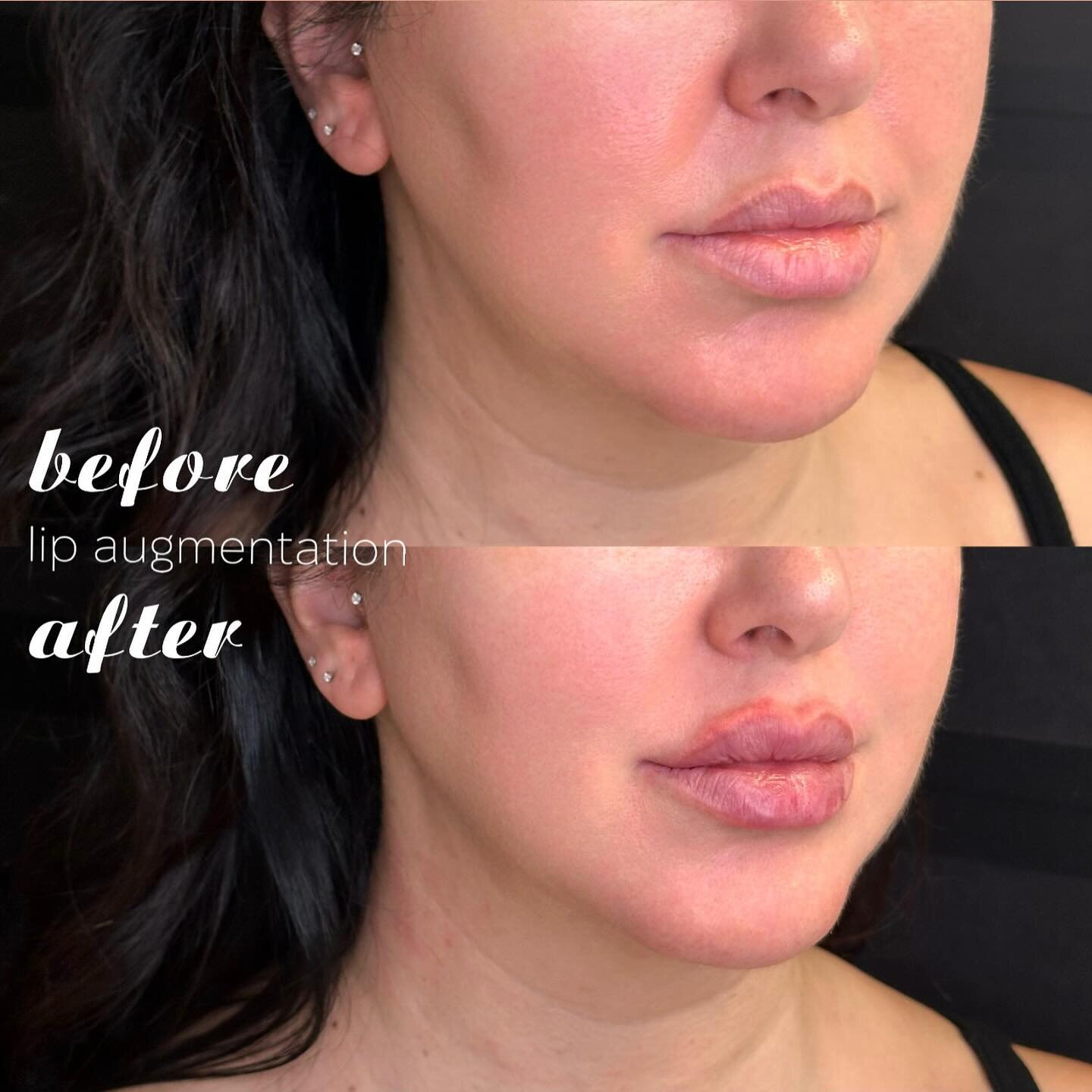 Lip filler to turn back time! 👄 She was born with gorgeous lips. Overtime slowly with aging her lips started loosing volume not so much in height, but in width. 
 
☑️ Lip augmentation was done to replace, lost volume. 
This is another great example 