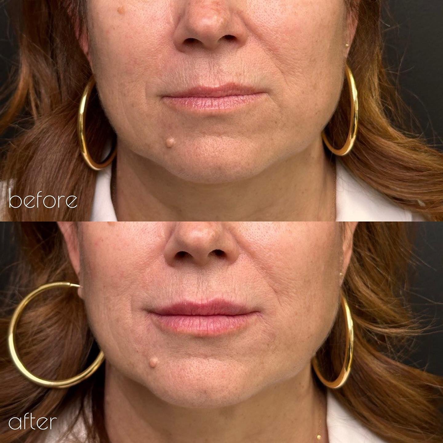 If you are noticing age related changes in your lips, but afraid to do a treatment due to looking fake, this example is for you ⬆️

This is a great example of how we lose volume overtime with aging. As lips 👄 lose volume, we develop vertical wrinkle