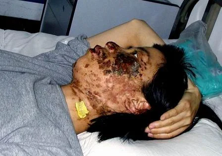 瀋陽法輪功學員高蓉蓉被電棍毀容後被進一步迫害致死(明慧網)