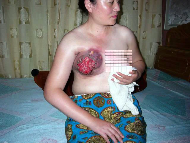 遼寧省法輪功學員王雲潔被電擊乳房數小時,致使整個乳房完全潰爛。