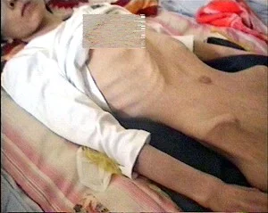 王霞 30歲,被呼和浩特女子監獄摧殘以及注射不明藥物,2004年6月體重只剩40多斤。