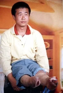 被酷刑失去雙腳的法輪功學員王新春又被惡警上「大鐵架子」折磨