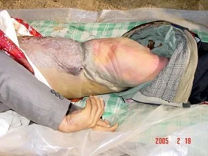 法輪功學員郭士軍被哈爾濱長林子勞教所毒打致死的證據,遺體傷痕纍纍