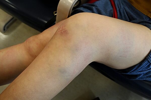 Bruises on Sarah Liang’s legs. Source: The Epoch Times.