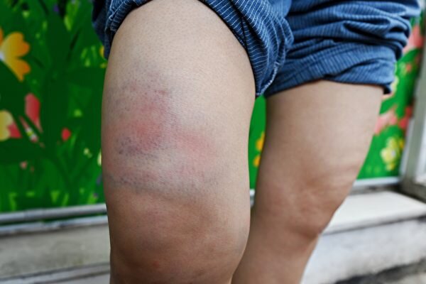 Bruises on Sarah Liang’s legs. Source: The Epoch Times.