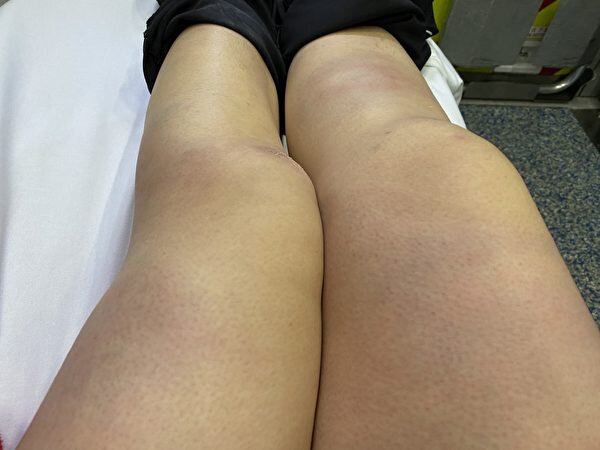 Bruises on Sarah Liang’s legs. Source: The Epoch Times.