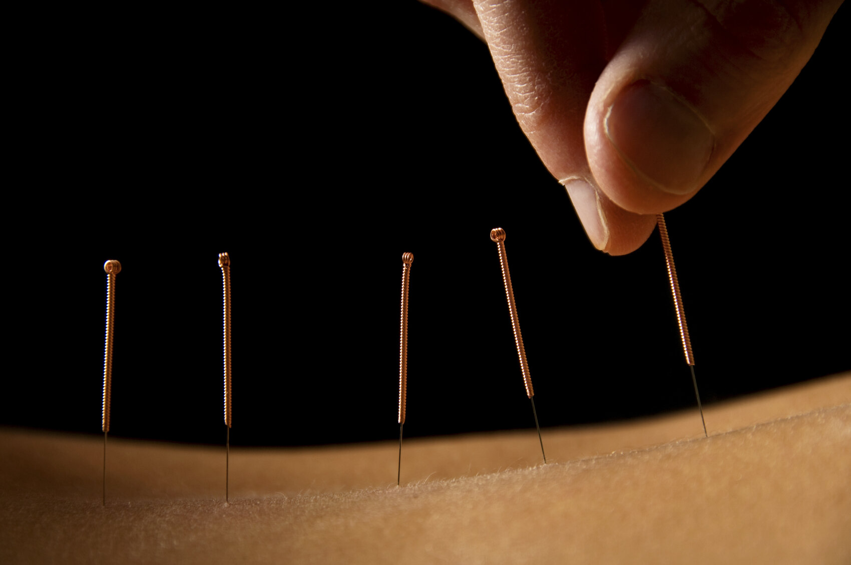 acupuncture-for-headache.jpg