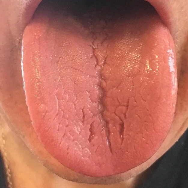 Sugar Doesn’t Cause Dampness