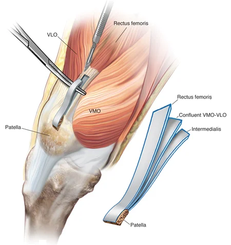 ACL_Repair_Options_ACL_Hsmstring_Graft.jpg