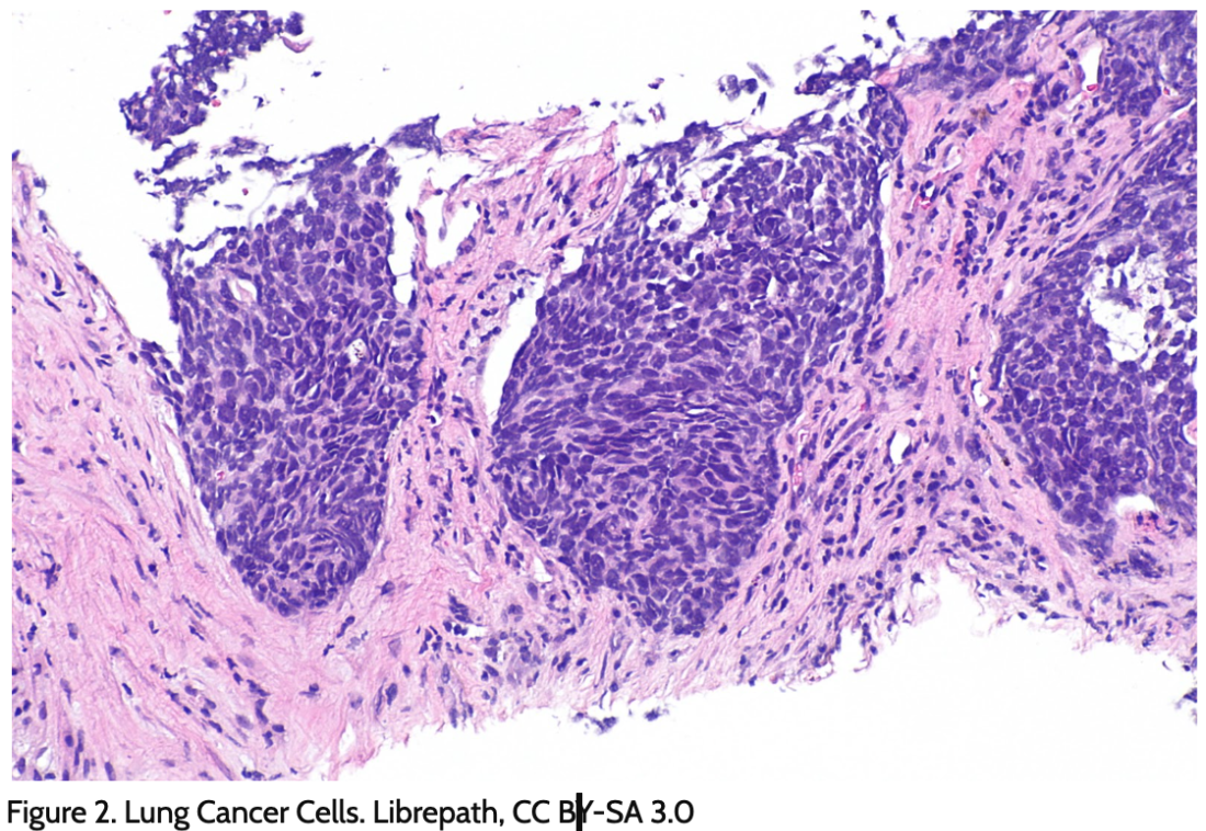 B.3 Lung Cancer.png