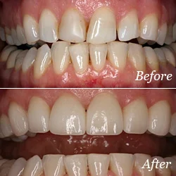 veneers.jpg