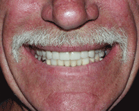denture1-2.png