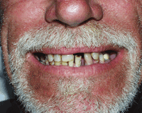 denture1-1.png