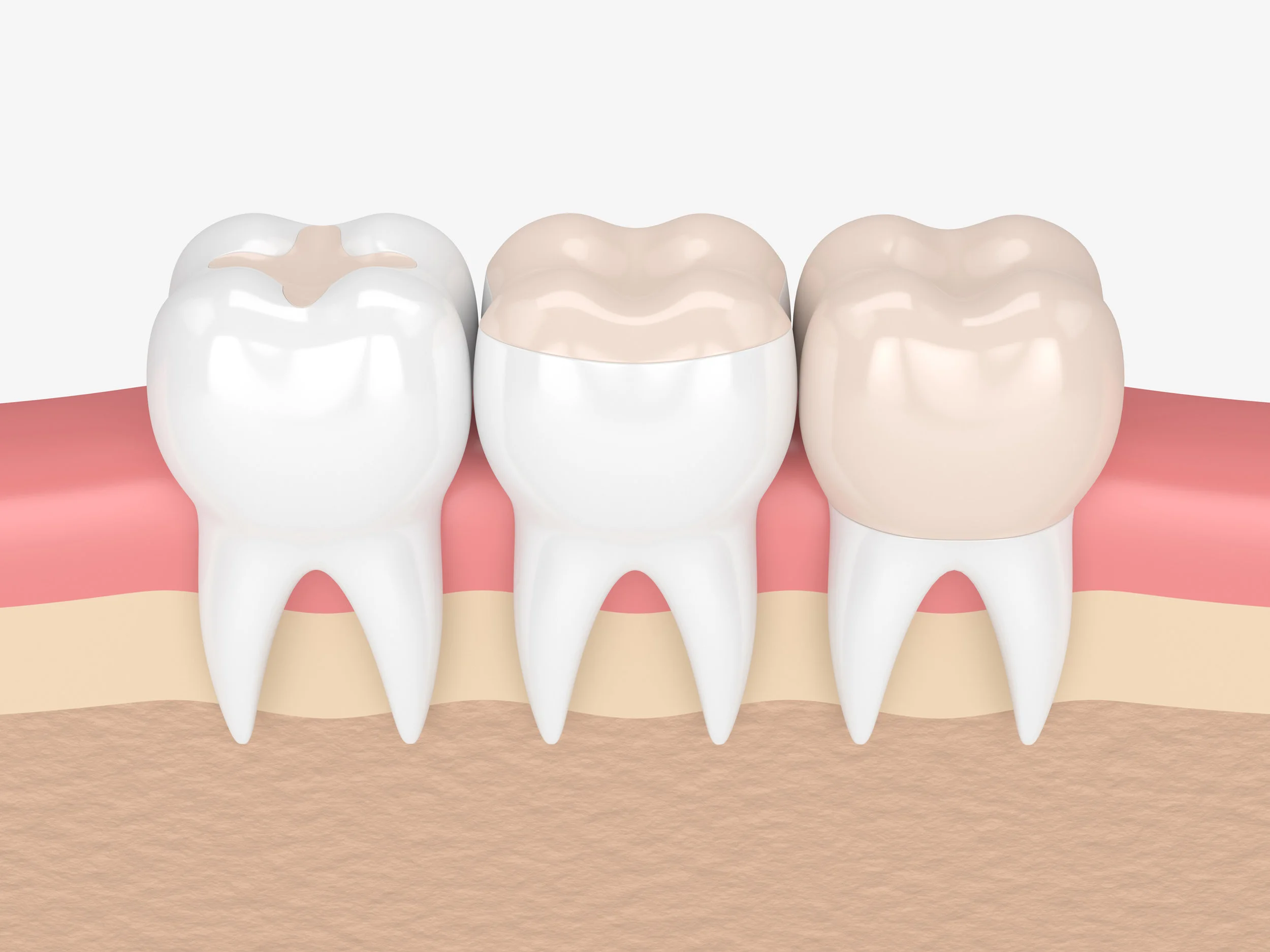 Fillings-Composite.jpg
