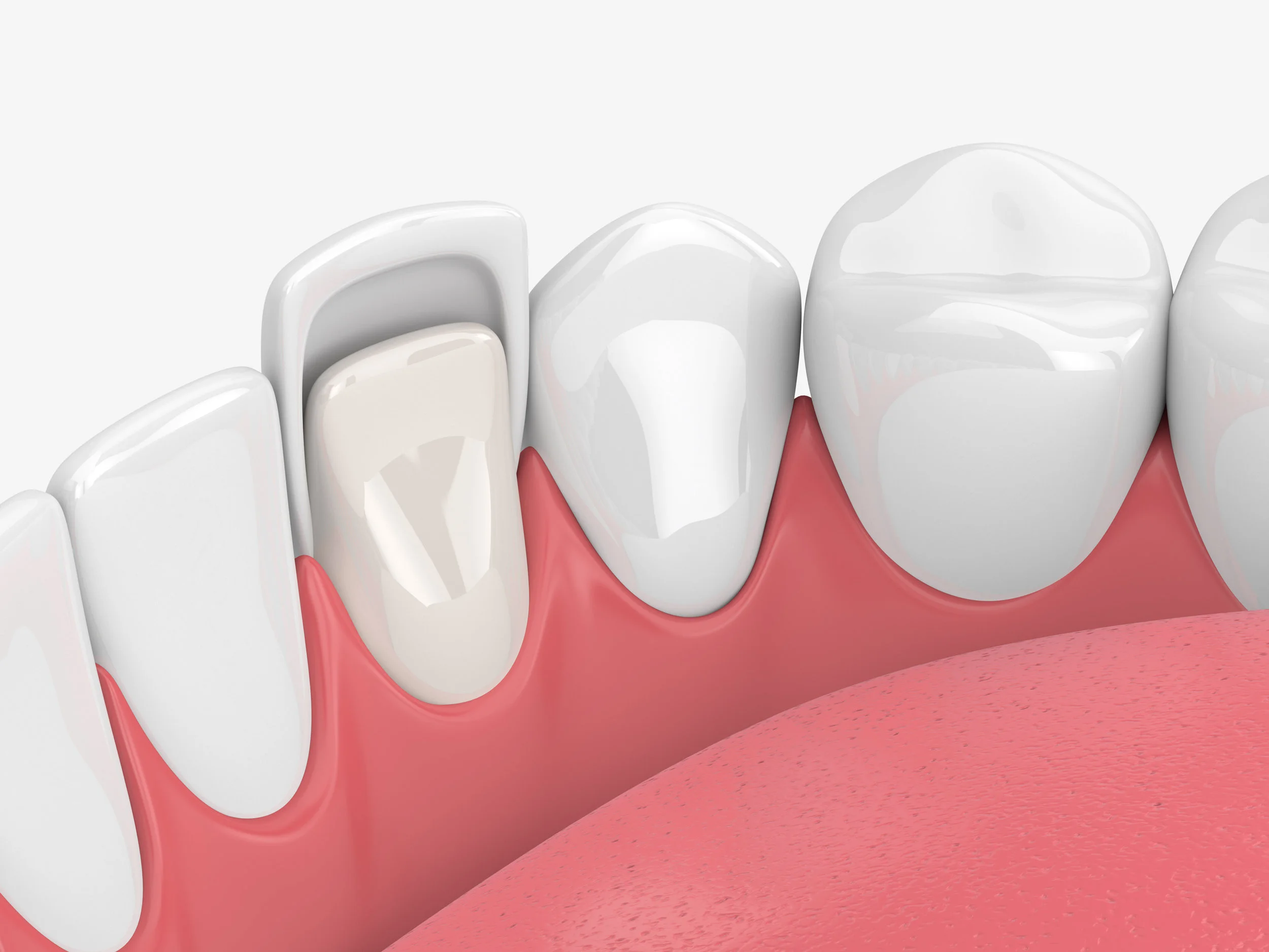 Veneers1.jpg