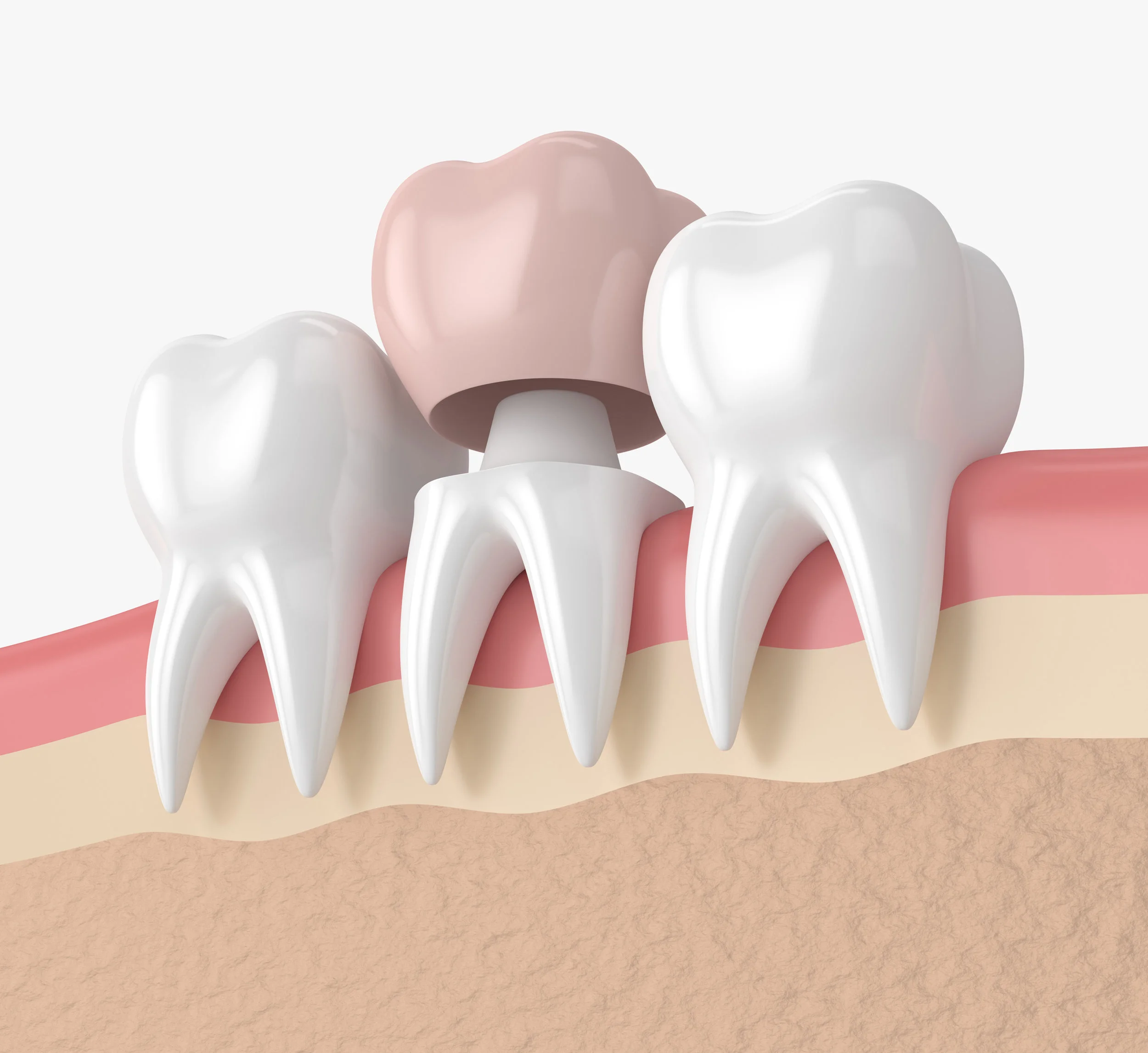 Looking to get Dental Crowns? Here’s some heart issues we’ll need to know about