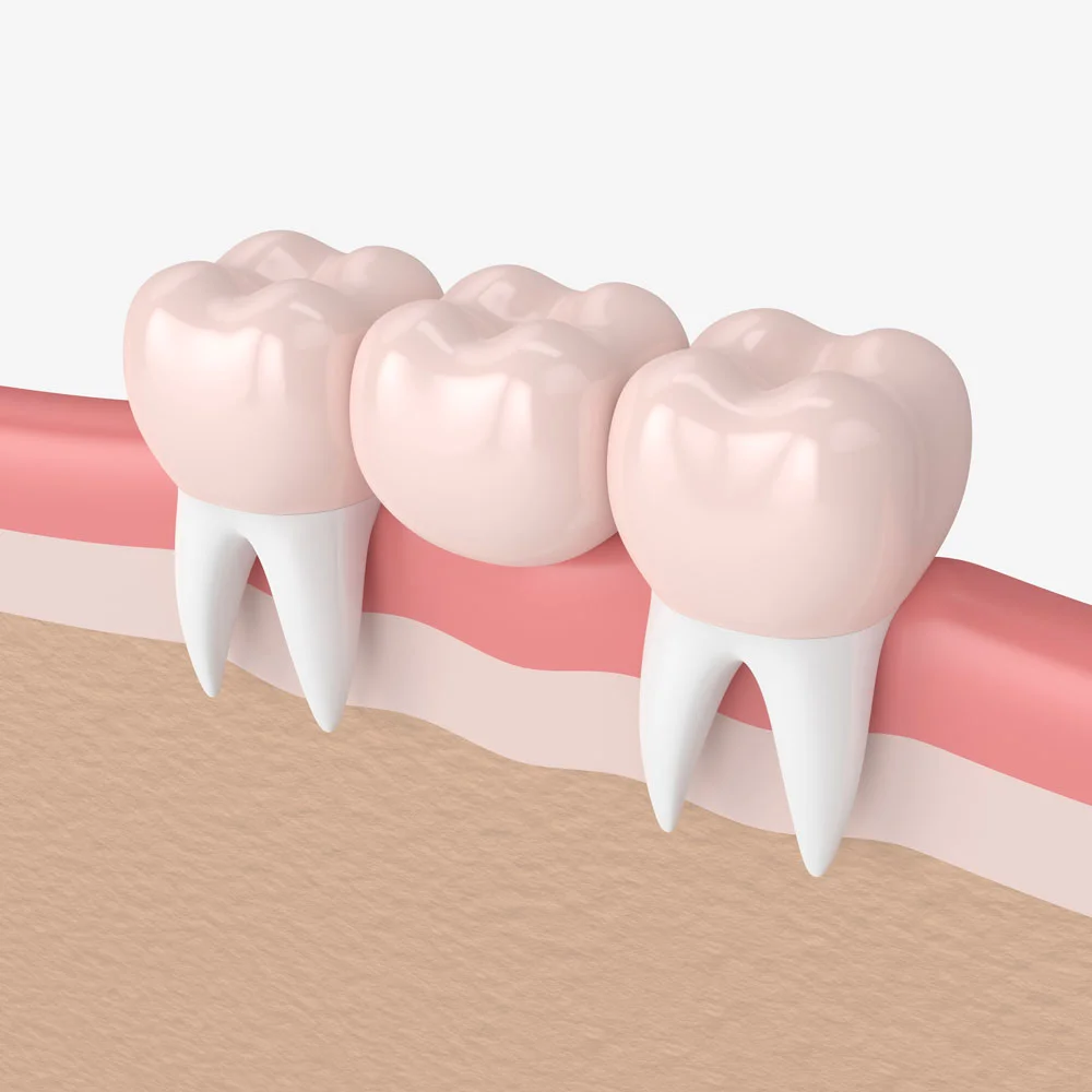 Looking after your dental bridges