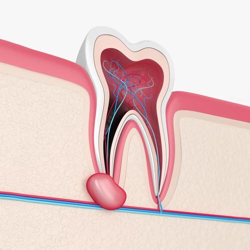 Kowhai-Dental-Tooth-Ascess1-500px.jpg