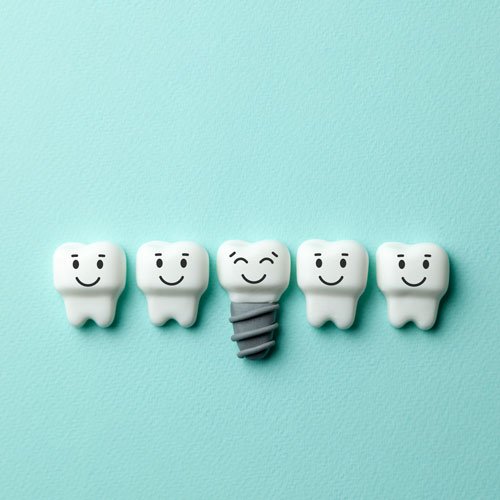 dental implants newport