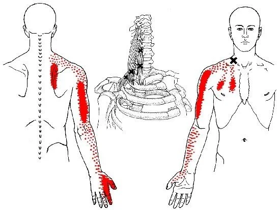 Thoracic Outlet Syndrome Program