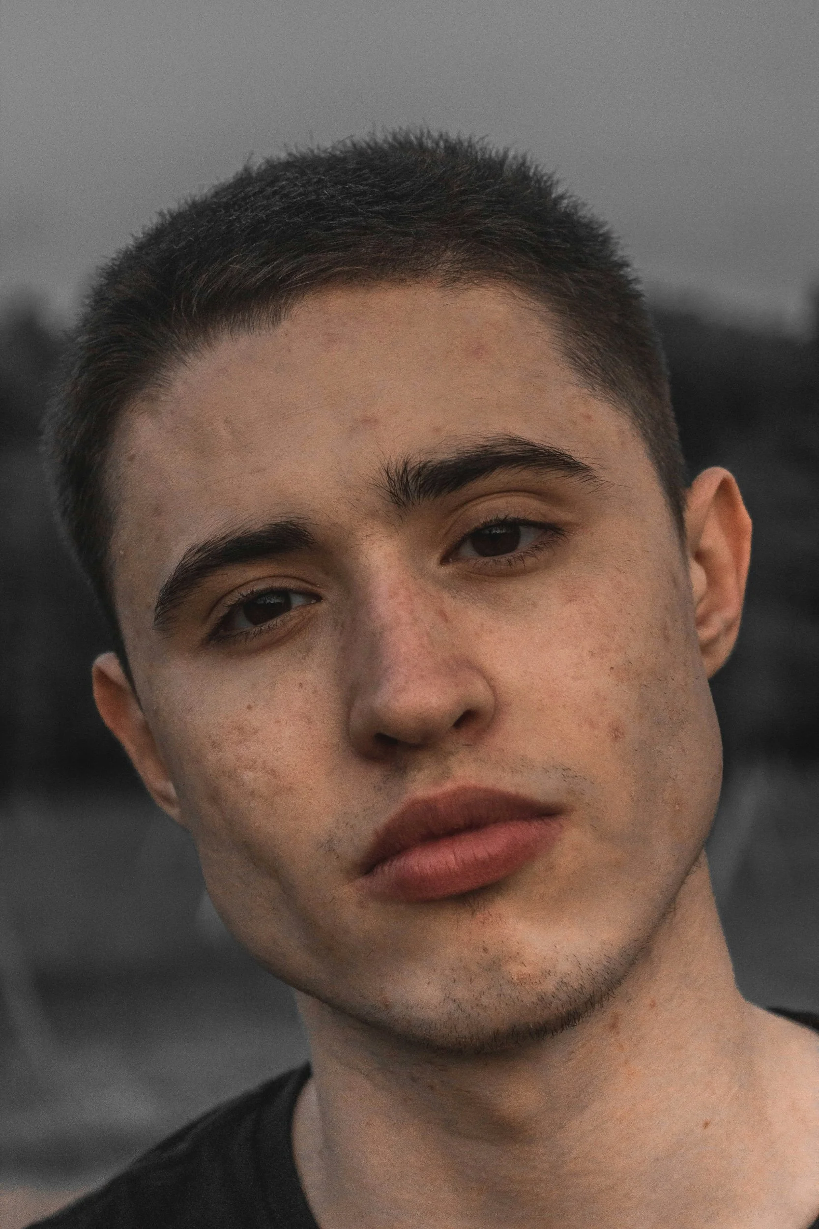 The Complex Relationship Between Diet, Dairy, and Acne: Navigating Sensitivities and Seeking Alternatives