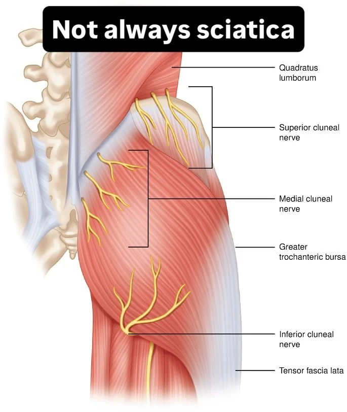 A clean MRI does not always mean a healthy back. One of the most overlooked sources of &ldquo;sciatica&rdquo; sits just above the pelvis: the superior cluneal nerve.

This small sensory nerve crosses the top of the iliac crest through a narrow tunnel