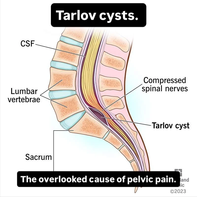 Pelvic pain with sciatica and bladder urgency that never fit together? Consider Tarlov cysts.

These are perineural sacs of cerebrospinal fluid (CSF) that arise from the nerve root sleeve, usually in the sacrum. They form where the meningeal covering