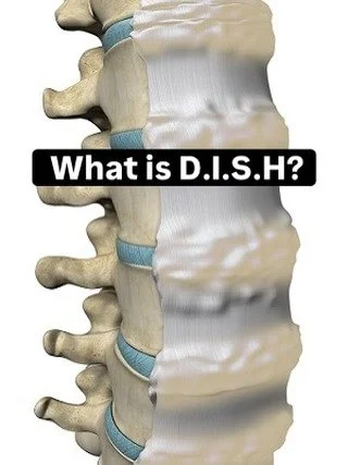 If your spine feels like it is slowly turning to bone and no one can explain why, read this.

Diffuse Idiopathic Skeletal Hyperostosis, DISH, is a common yet underdiagnosed cause of spinal stiffness. It is extra bone forming along ligaments where the
