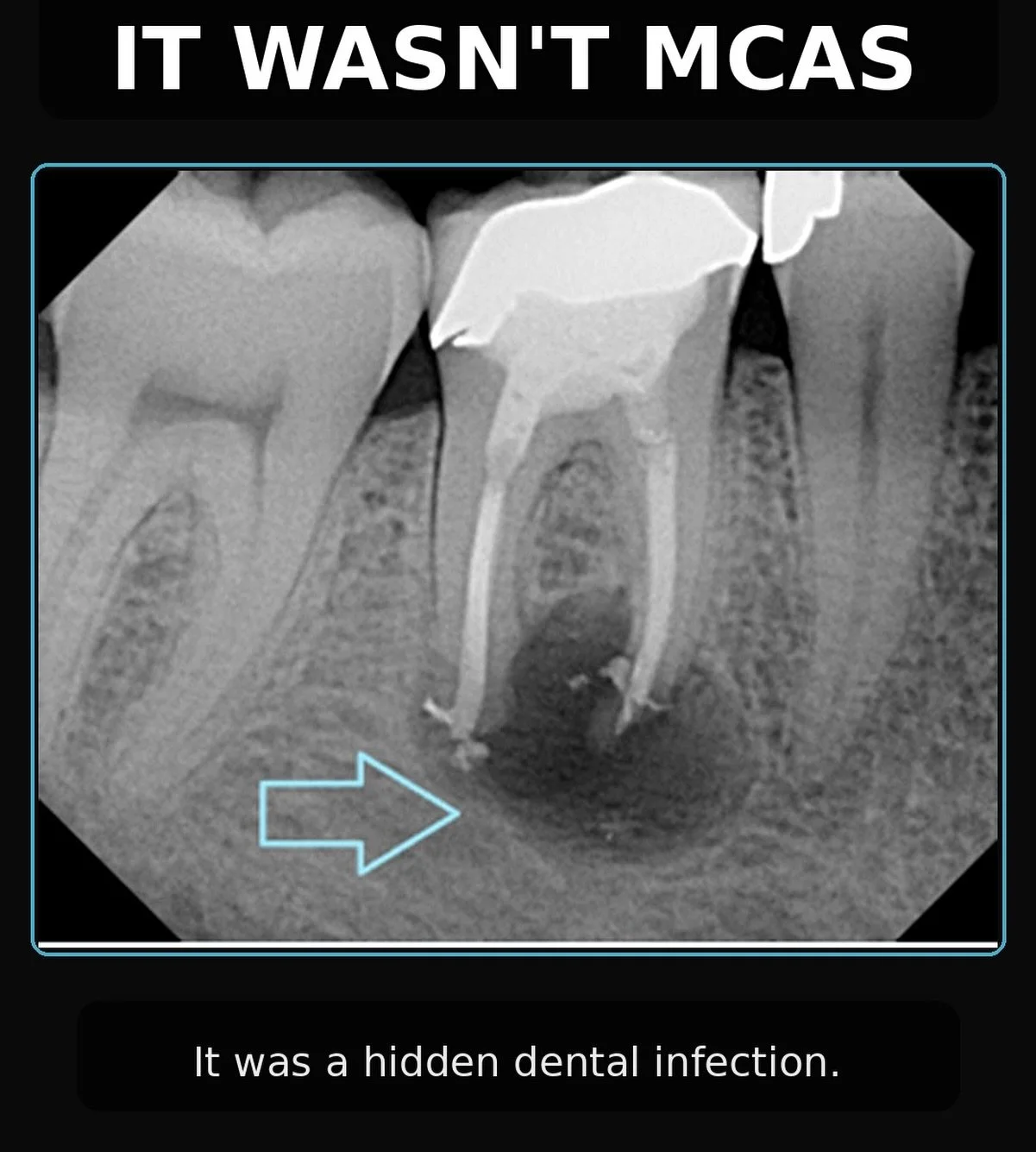 It wasn&rsquo;t MCAS.

Quick context: MCAS, mast cell activation syndrome, is when mast cells, immune cells involved in allergic reactions, release too many inflammatory mediators and create symptoms like flushing, hives, swelling, rapid heart rate, 