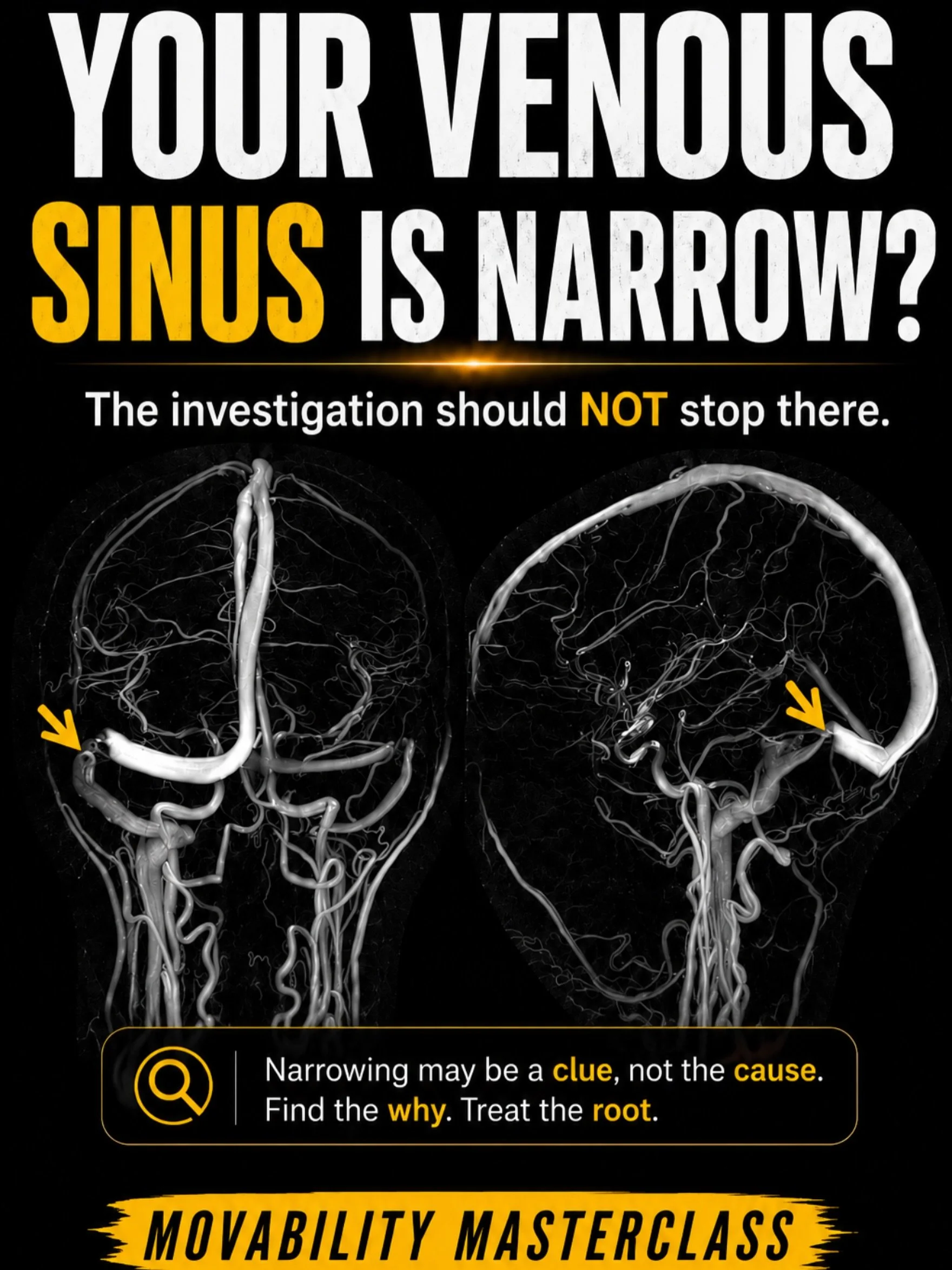 You were told your cerebral venous sinus is narrow.

But were you ever told why?

For many people, that is exactly where the investigation stops. They are shown an MRV, given a label, and left without an explanation for what narrowed it, whether it i