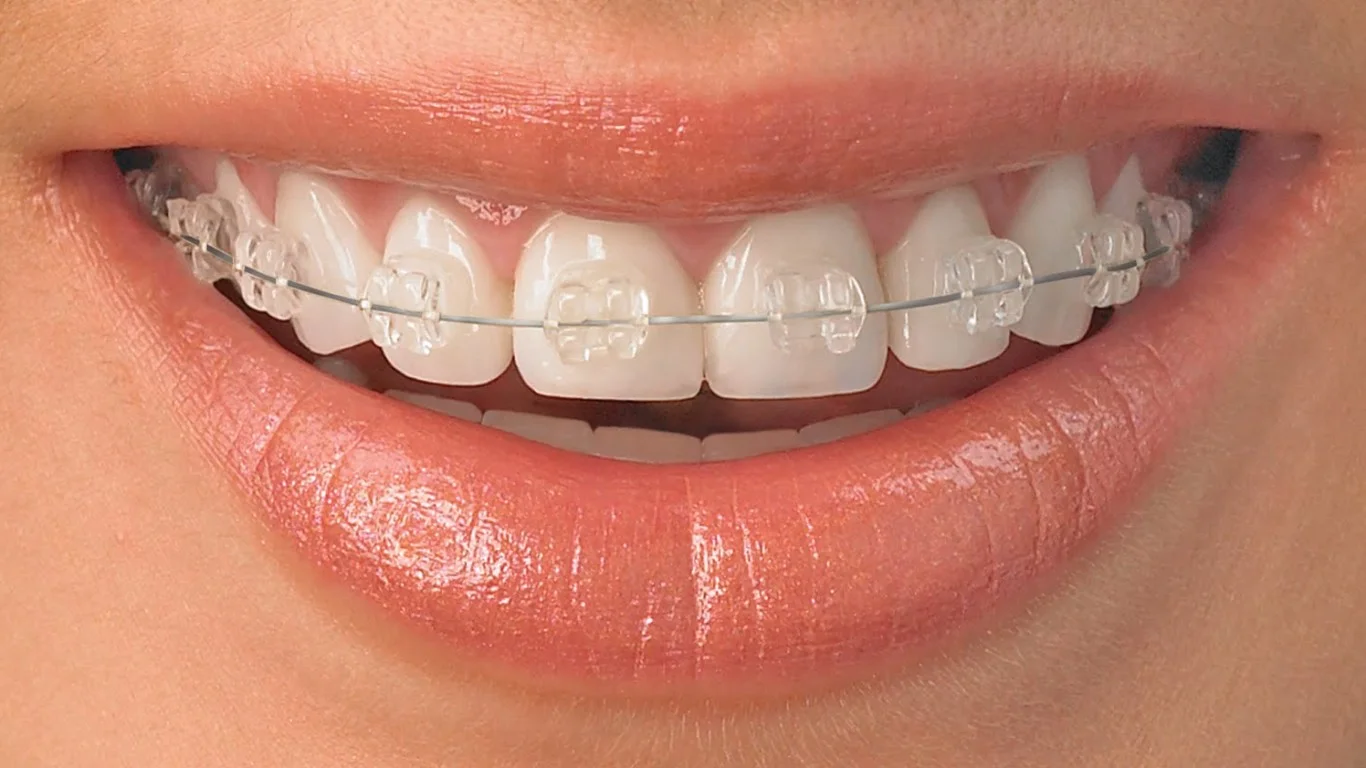 clear-orthodontic-braces-1366x768.jpg