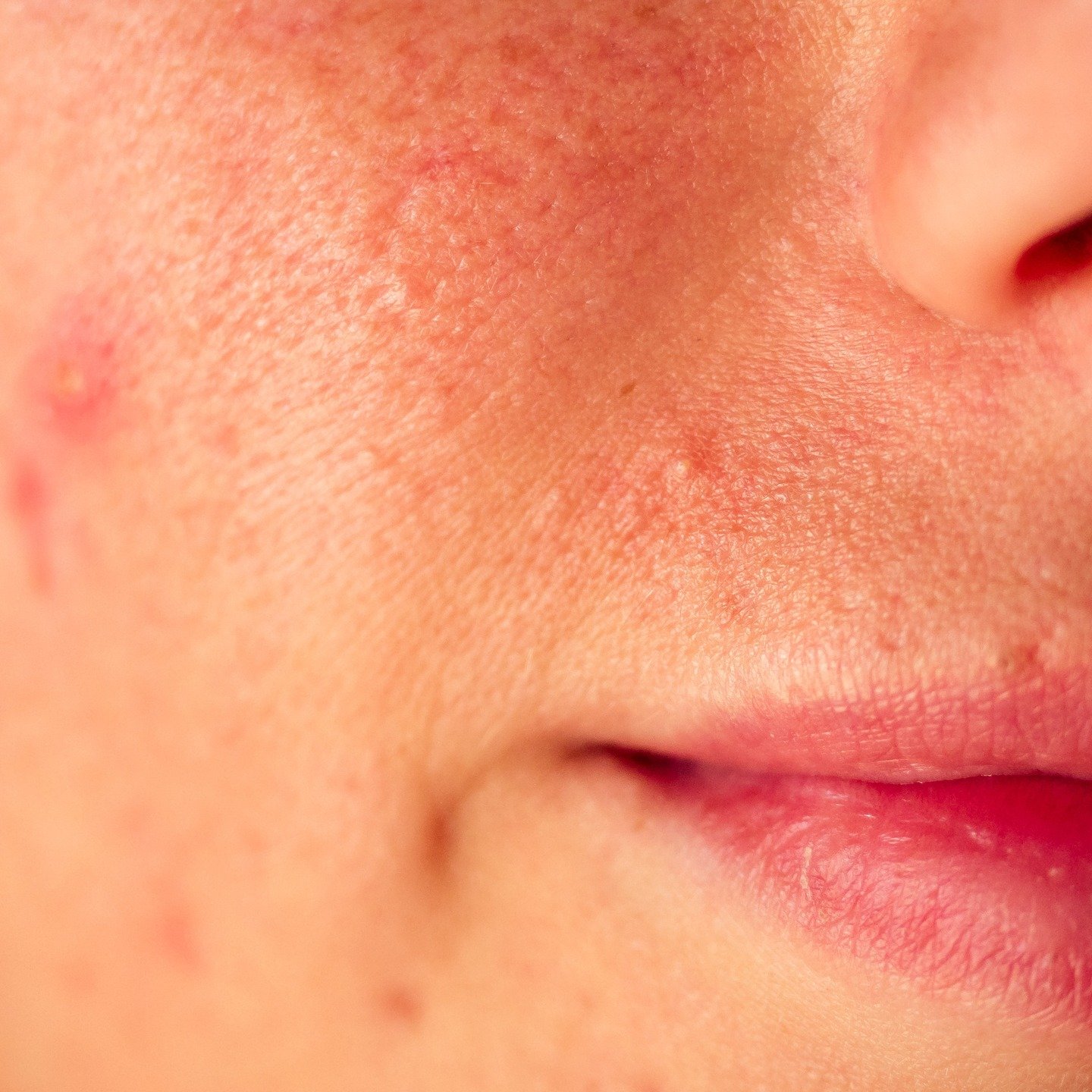 Rougeurs, picotements, petits boutons: ce sont souvent des signaux de barri&egrave;re cutan&eacute;e fragilis&eacute;e. Les actifs trop forts et les routines trop longues aggravent fr&eacute;quemment la situation.

&Agrave; la Clinique Bleu Vert: dia