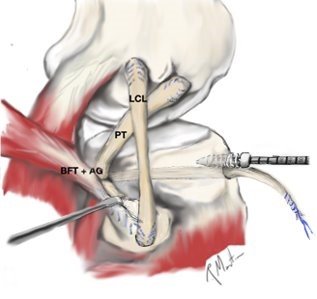 Posterior Lateral Corner (PCL)