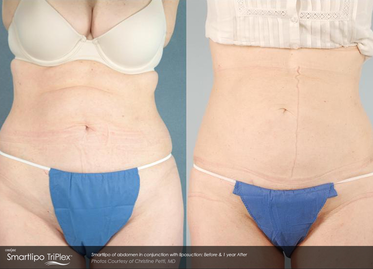 DiBernardo_Smartlipo-of-abdomen-in-conjunction-with-liposuction-1-year-post.jpg