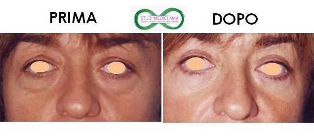 BLEFAROPLASTICA 5.jpg