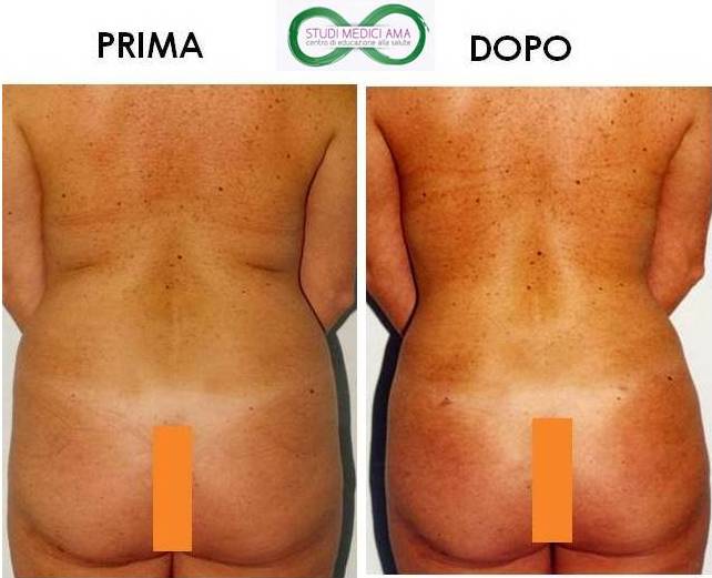 LIPOSUZIONE DONNA DI DIETRO.jpg