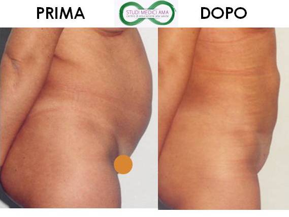 LIPOSUZIONE 3.jpg
