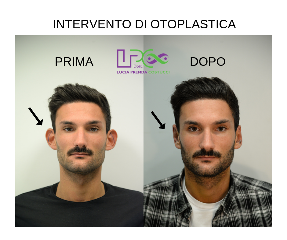 OTOPLASTICA UOMO.png