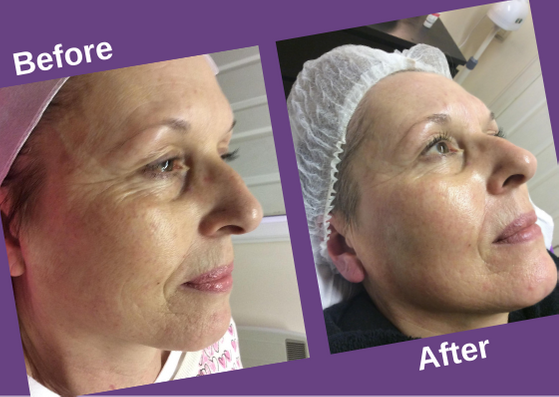 microneedling-before+and+after-montrose.png