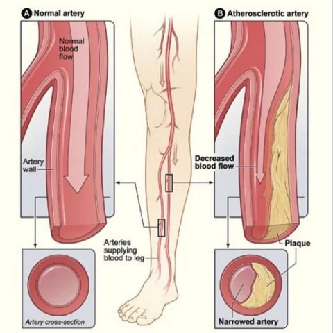 Vascular Disease s
