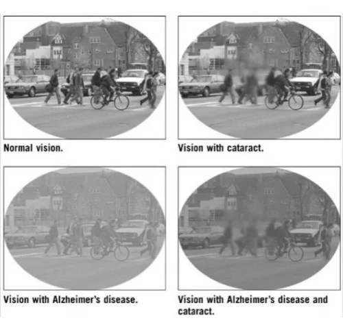 Alzheimer’s & Cataracts - Vision