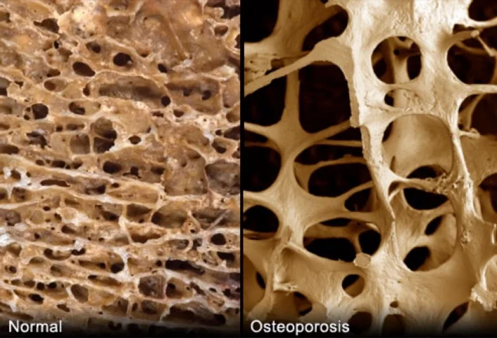 osteoporosis.jpeg