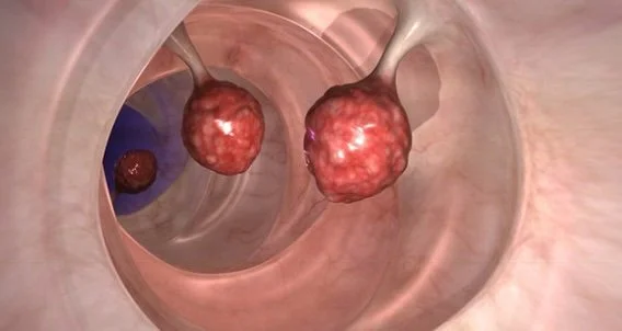 Colon Polyps & Cancer