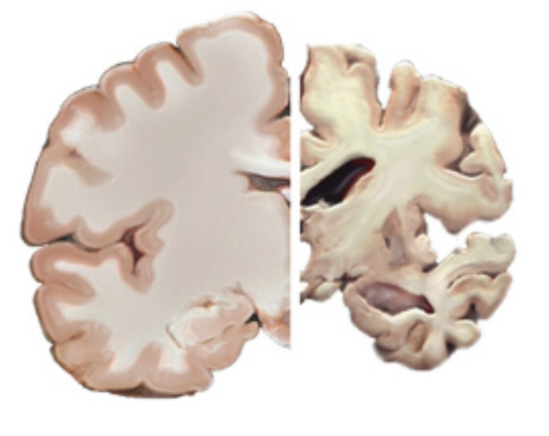 101 Understanding Dementia