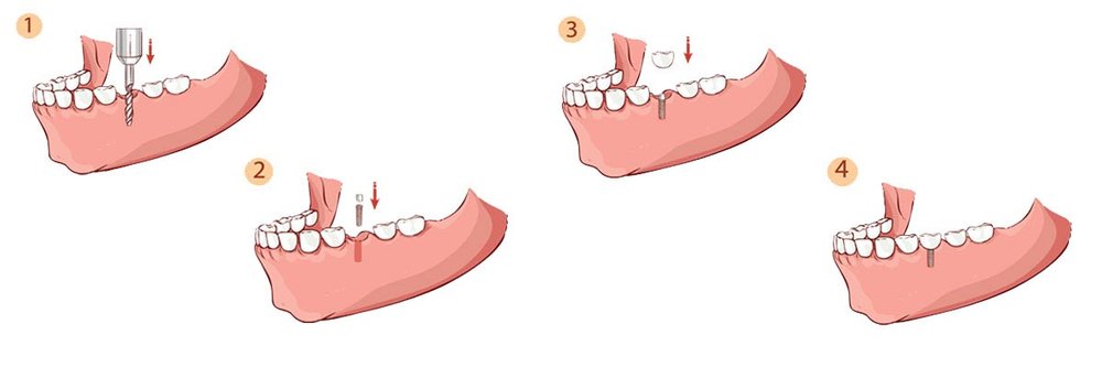 The+Dental+Implant+Procedure_Header.jpg