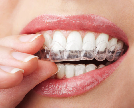 As an Invisalign® Dentist in Fremont, We Can Provide Your Teen With Cosmetic Dentist Solutions