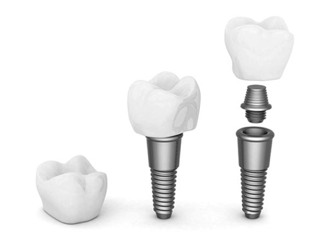 Dental Implants vs. Dental Bridges