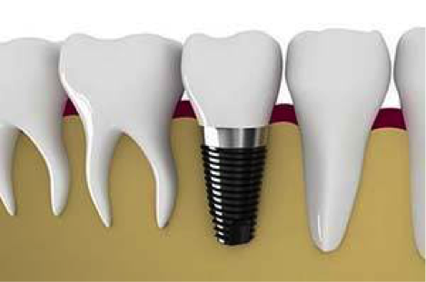 How Dental Implants are Placed in the Jawbone