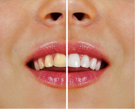 Teeth Whitening and Sensitive Teeth: Tips From the American Dental Association