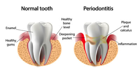 Periodontics Can Save Your Smile by Restoring Your Gums